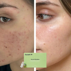 Acne Infusion