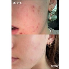 Acne Infusion